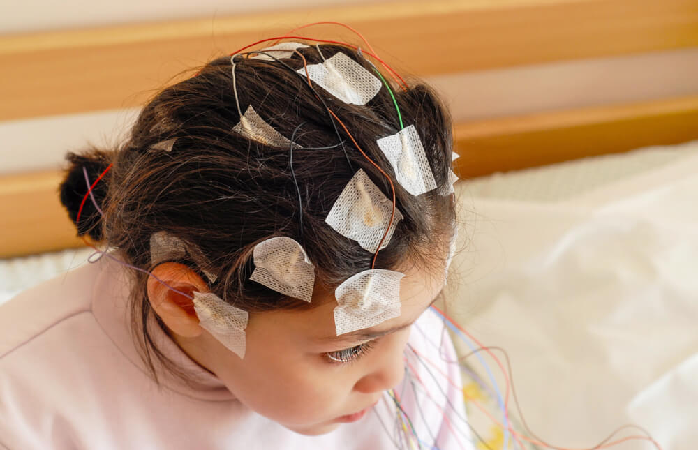 epilepsia refrataria 3 tratamentos disponíveis de difícil controle infância 