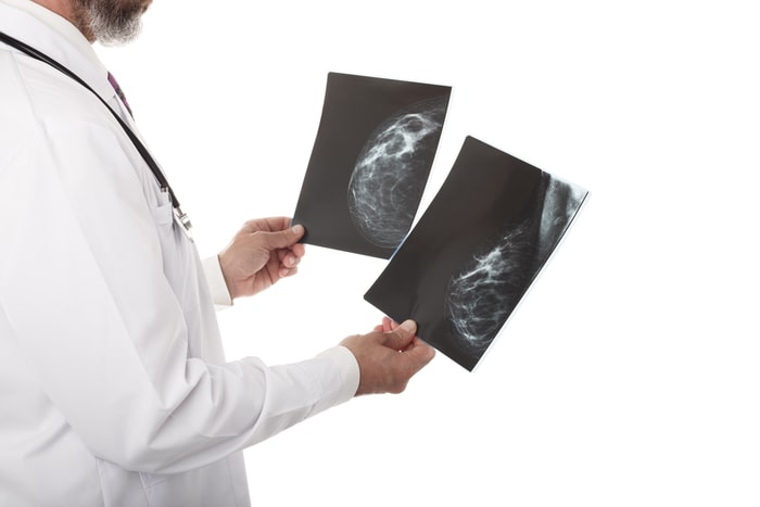 tipos de carcinoma de mama analise