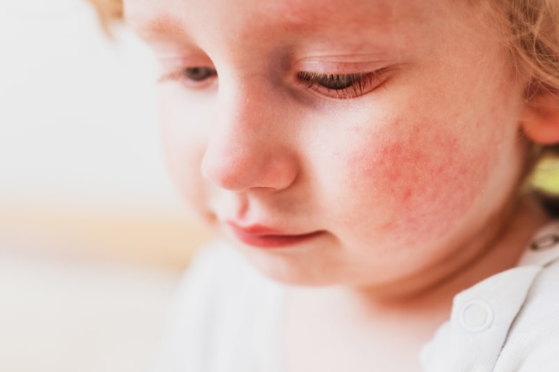 remedio para alergia crianca