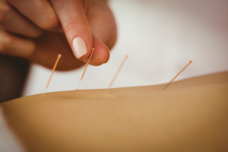 beneficios da acupuntura agulhas