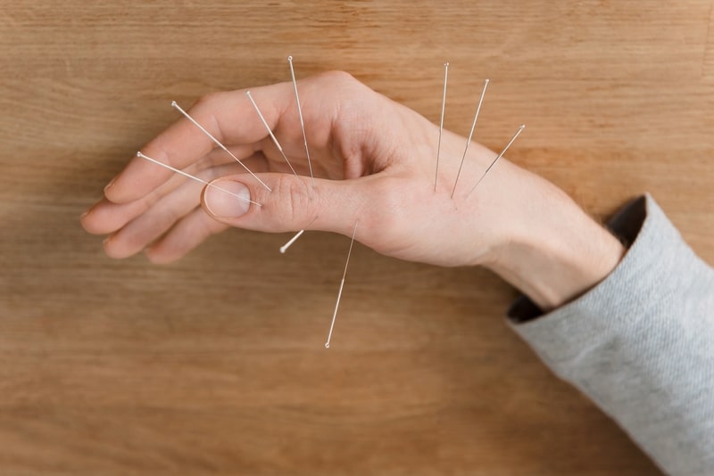 beneficios da acupuntura maos