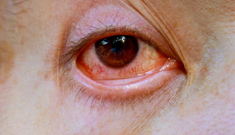 tratamento para glaucoma olho