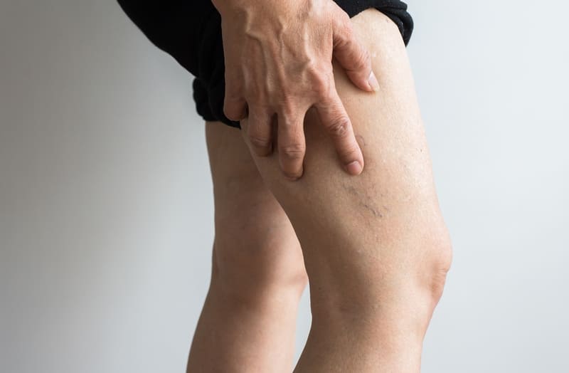 doenças vasculares nas pernas
