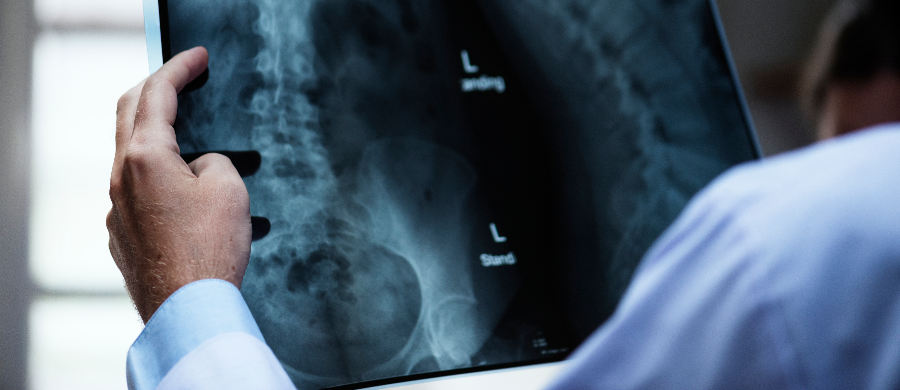 Em estudo pré-clínico, CBD preveniu a osteoporose