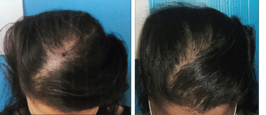 Foto mostra o antes e depois do tratamento com Cannabis para alopecia
