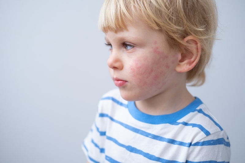 eczema tratamento crianca