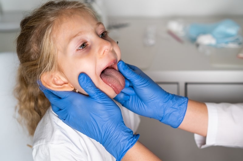 ulcera bucal crianca