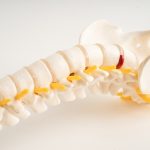 tratamentos para espondilose