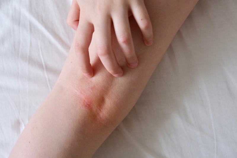 tratamento da erisipela grave