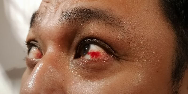 cbd glaucoma cbd glaucoma