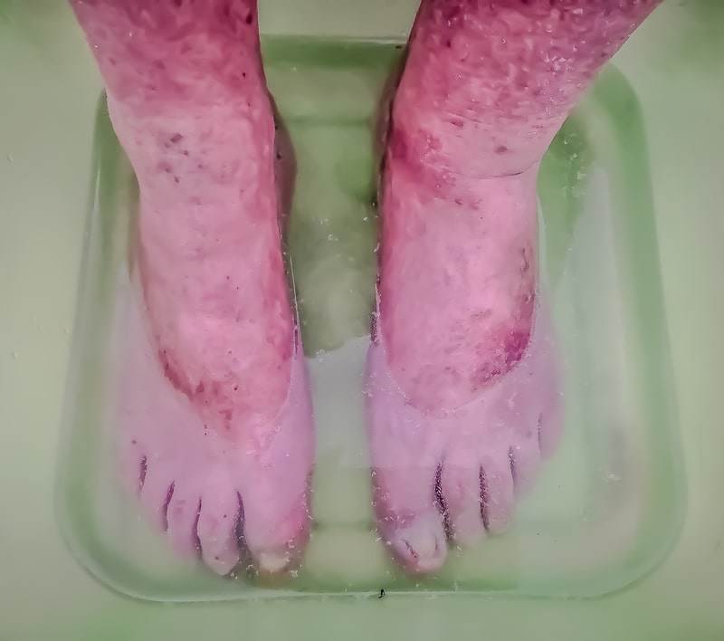 doenca vascular periferica pes enchados