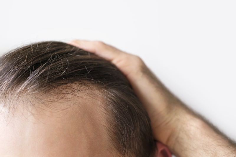 doencas autoimunes alopecia