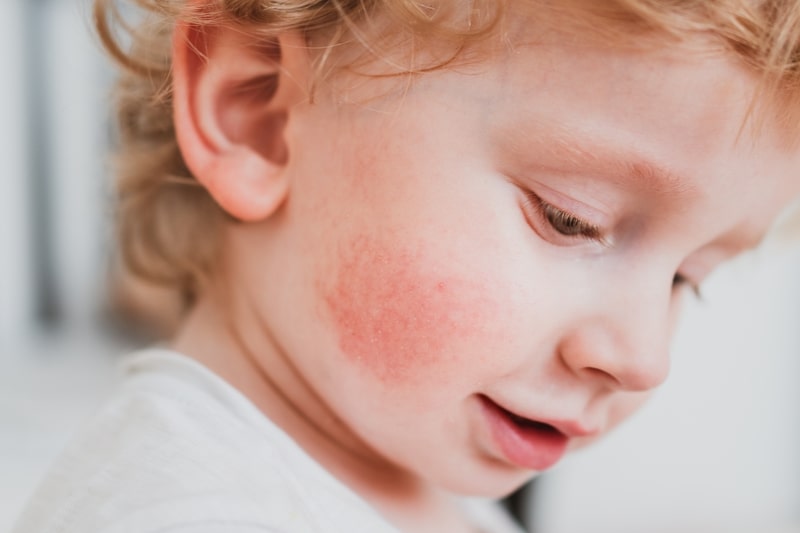 eczema tratamento bebe
