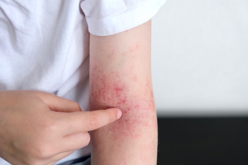eczema tratamento pustulas
