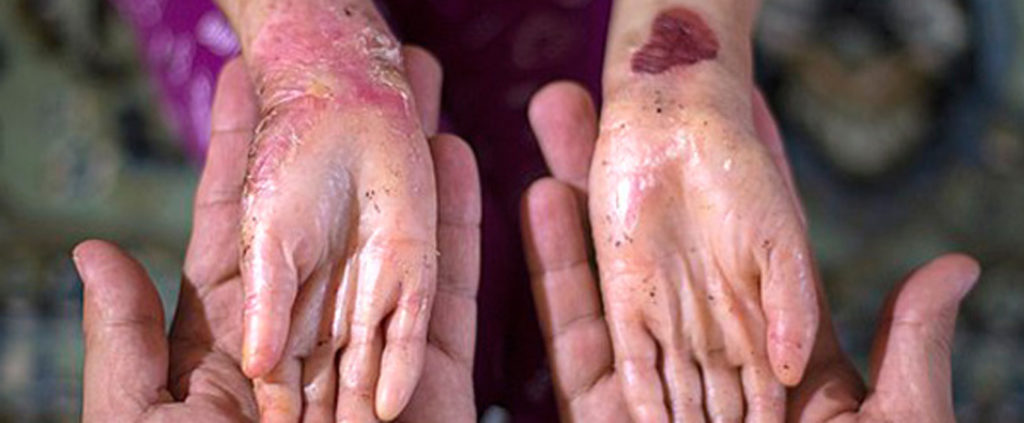 epidermólise bolhosa