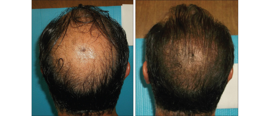 À esquerda o participante no dia zero do tratamento, à direita após 6 meses de tratamento com tônico capilar com extrato de Cannabis