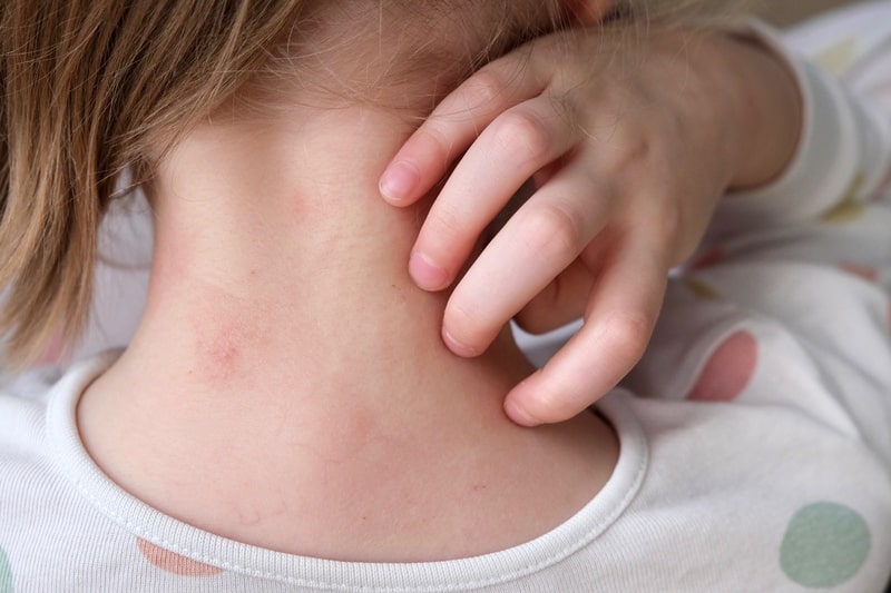 lupus eritematoso sistemico crianca