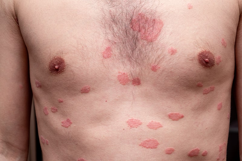 lupus eritematoso sistemico manchas