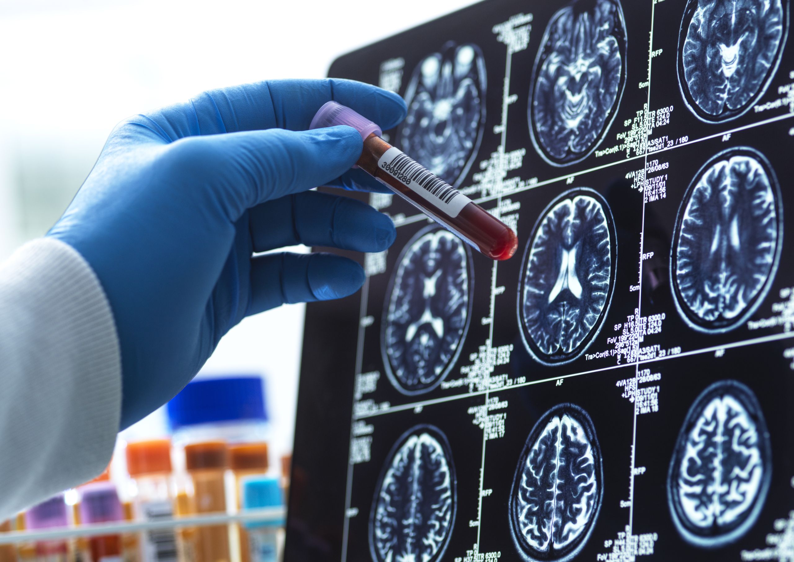 CB1: cientistas identificam como ele protege cérebro contra depressão e estresse