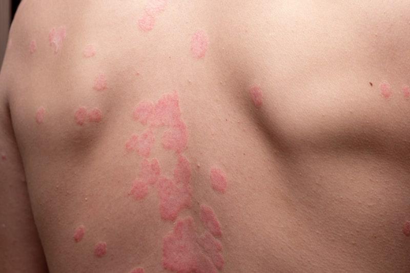 tratamento psoriase ferida nas costas