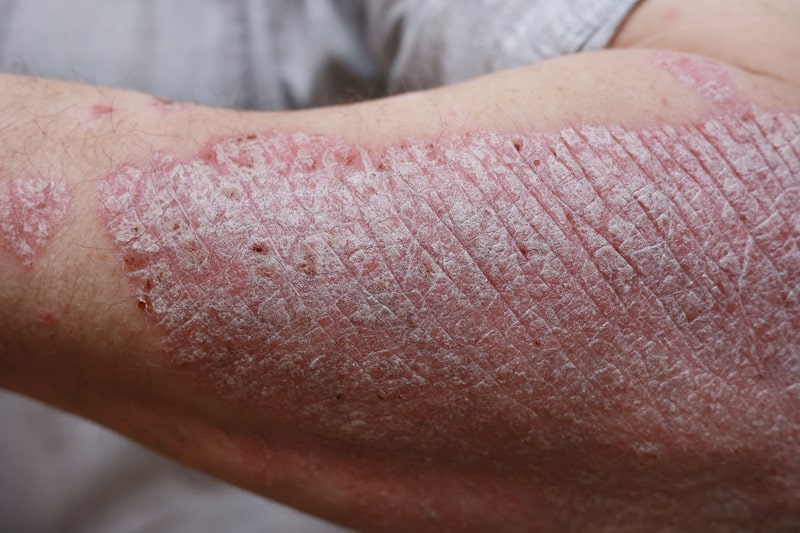 tratamento psoriase machucado