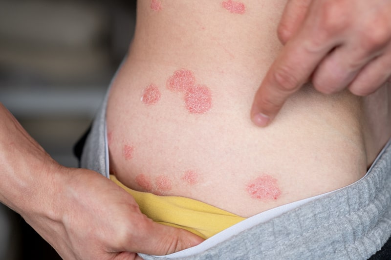 tratamento psoriase manchas