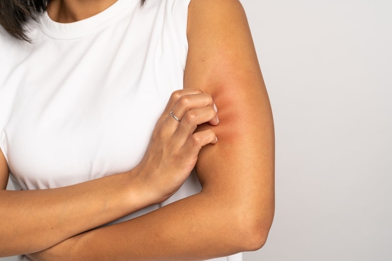 tratamentos para alergia alimentar coceira