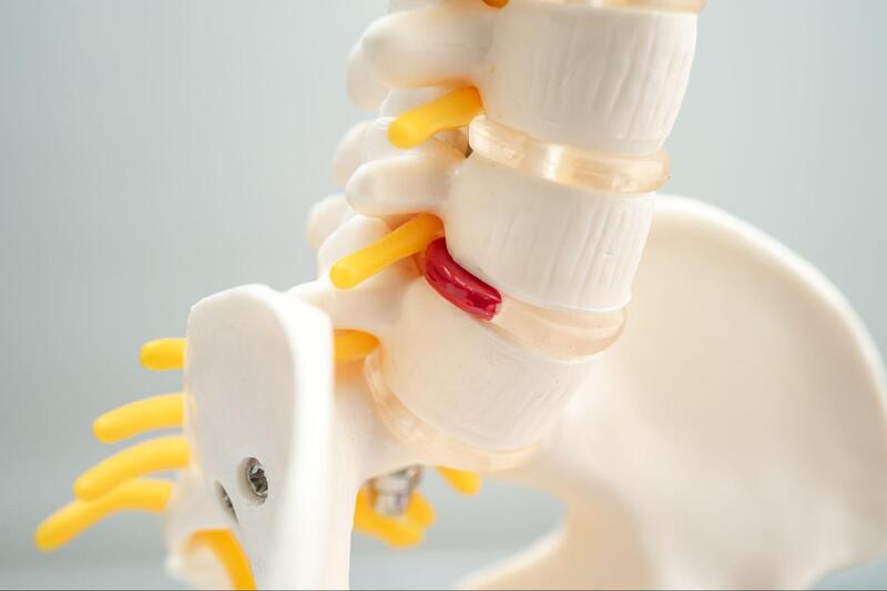 tratamentos para espondilose vertebra