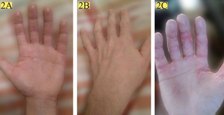 A foto 2C mostra a palma da mão do paciente antes do tratamento. As fotos 2A e 2B mostram a palma e as costas da mão após os três meses de aplicação da emulsão com óleo de semente de cânhamo