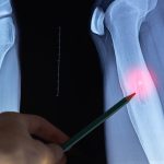 Cannabis ajuda paciente com sarcoma de Ewing a abandonar opioides