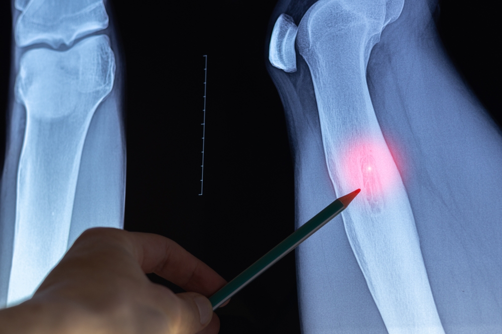 Cannabis ajuda paciente com sarcoma de Ewing a abandonar opioides