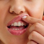 Canabidiol pode ajudar no controle da periodontite, aponta estudo