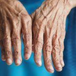tratamento para artrite remedios