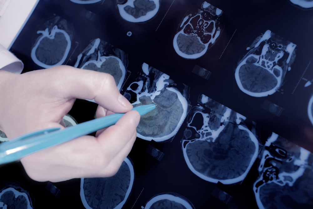 Universidade brasileira inicia estudo de 20 anos com Cannabis para prevenir Alzheimer