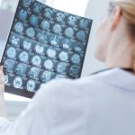 CBD diminui convulsões em 89% das pacientes com CDKL5, indica pesquisa