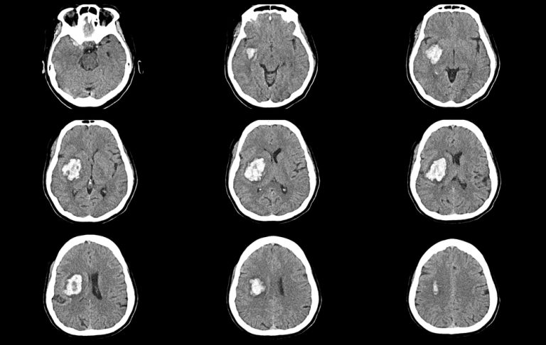 Estudo aponta neuroproteção da Cannabis após AVC isquêmico