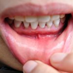 Estudo indica potencial do CBD para saúde da gengiva