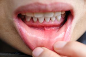 Estudo indica potencial do CBD para saúde da gengiva