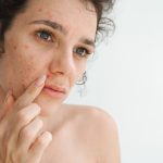 CBD contra acne: revisão analisa benefícios e limites