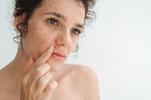 CBD contra acne: revisão analisa benefícios e limites
