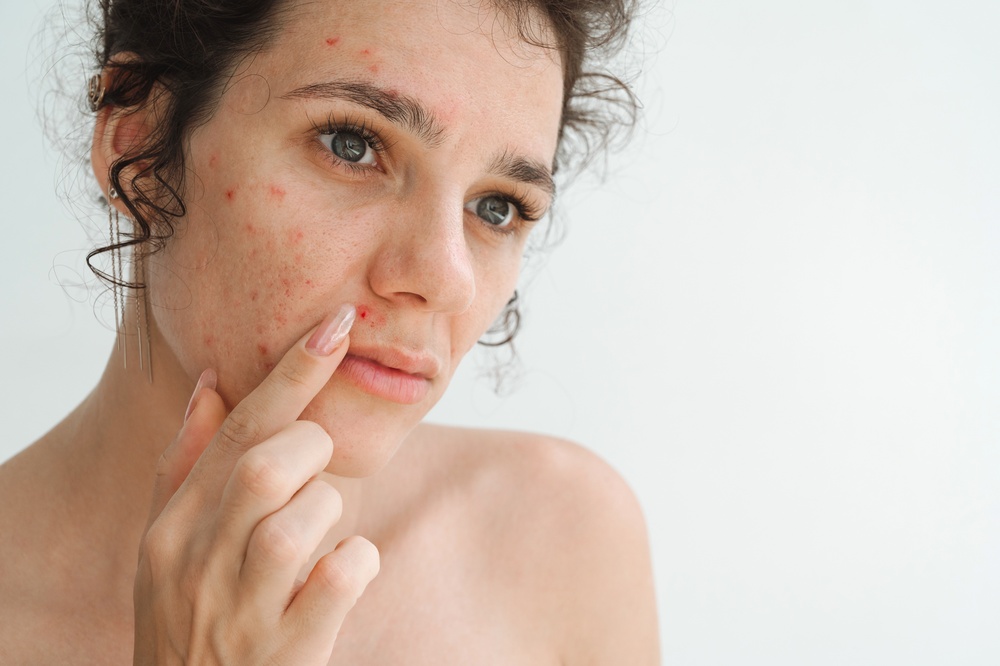 CBD contra acne: revisão analisa benefícios e limites