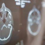 Relato descreve uso de CBD após lesão cerebral grave hiperatividade simpática paroxística