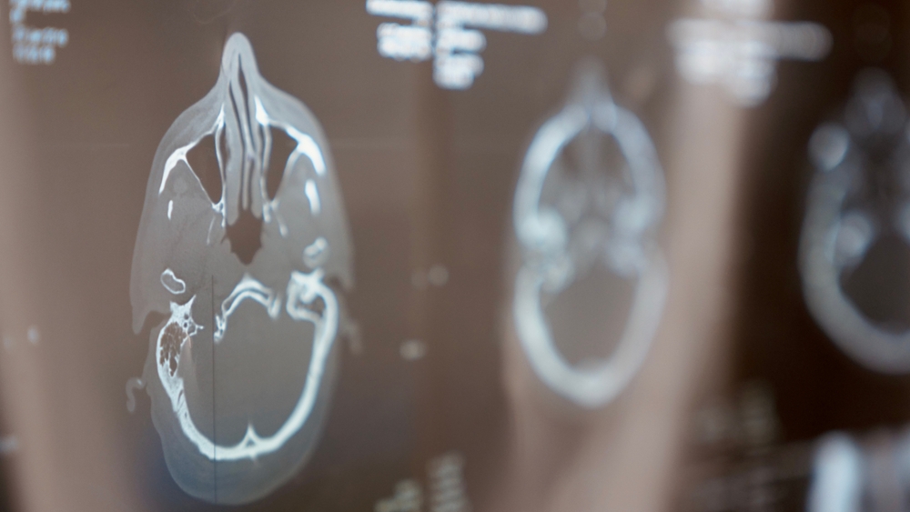 Relato descreve uso de CBD após lesão cerebral grave hiperatividade simpática paroxística