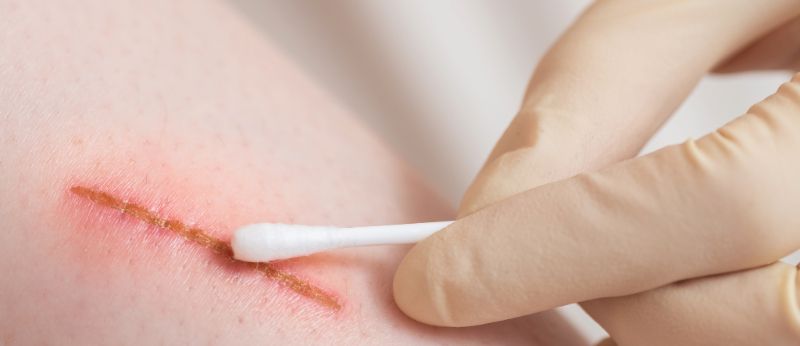 Fitocanabinoides na cicatrização de feridas: uma abordagem promissora