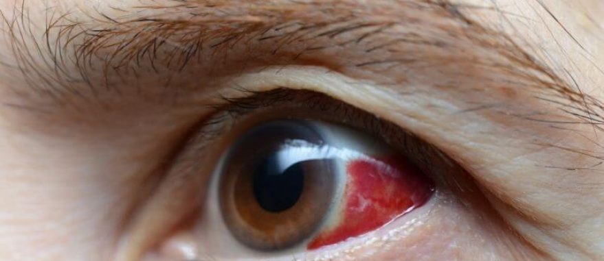 cbd glaucoma olho vermelho